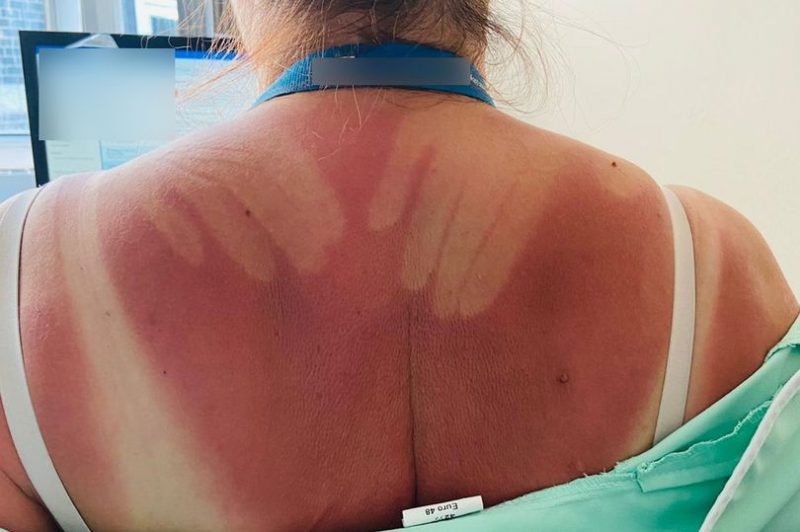 Manc mum&#8217;s sun cream fail leaves her looking like she spent the day &#8216;in arms of sexy hunk&#8217;, The Manc