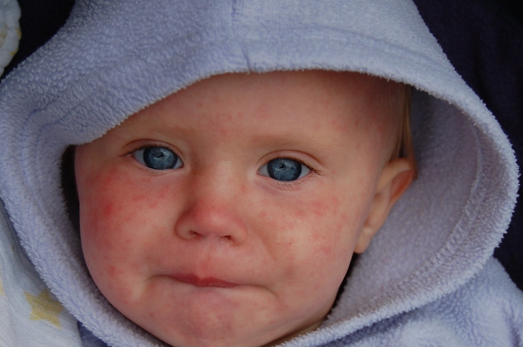 Measles warning issued after MMR jab rates drop to lowest level in a decade, The Manc