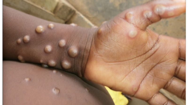 Two more cases of rare Monkeypox disease identified in England, The Manc