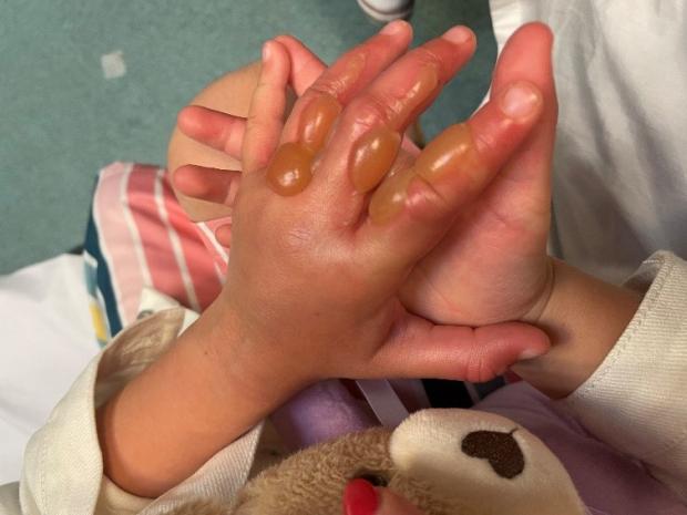 Child in Bolton left with horrendous burns after touching &#8216;Britain&#8217;s most dangerous plant&#8217;, The Manc