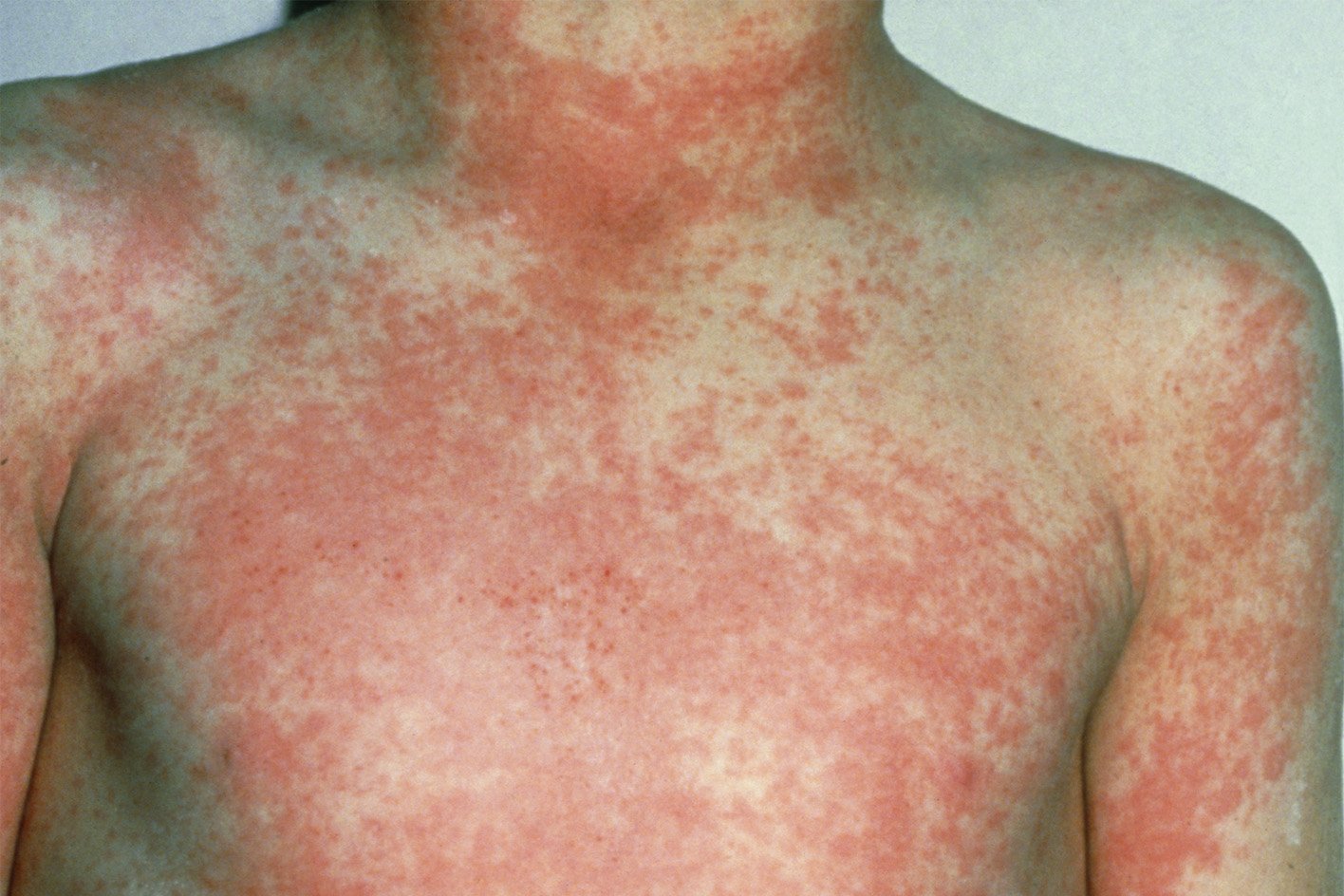 Scarlet fever rash - Strep A symptoms