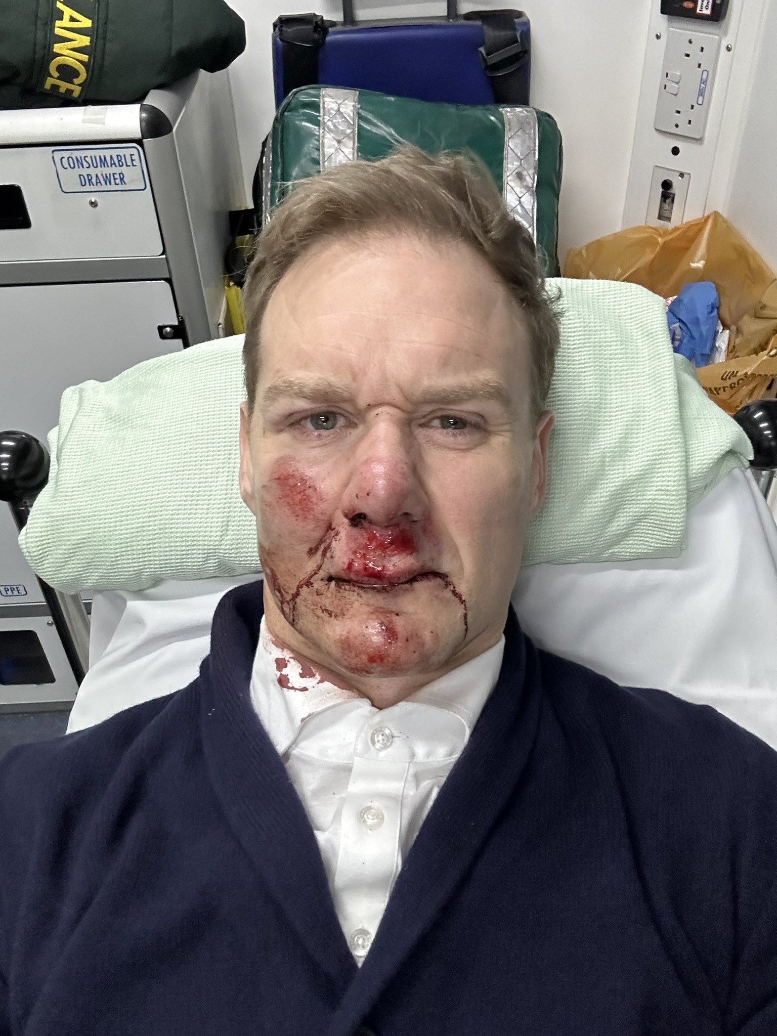 Dan Walker showing his injuries after his accident